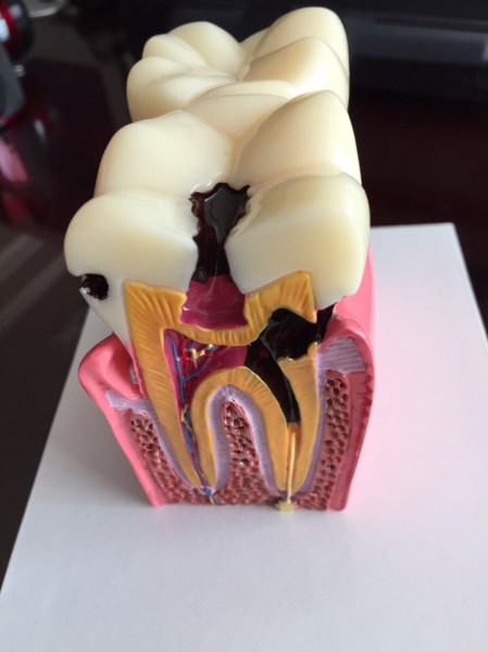 Mô hình răng sâu 2 cái - Vật Tư Nha Khoa Thiên Nam - Công Ty TNHH Vật Tư Nha Khoa Thiên Nam